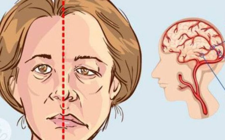 tác hại của căng thẳng mệt moi