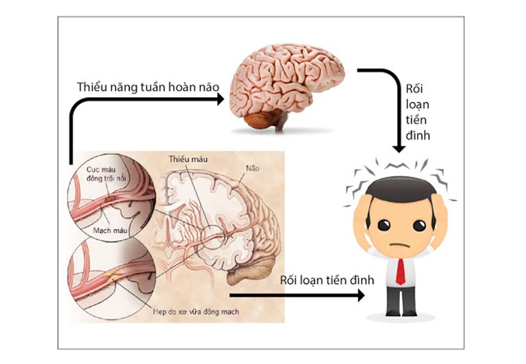 Rối loạn tiền đình