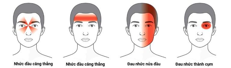 đau đầu kéo dài