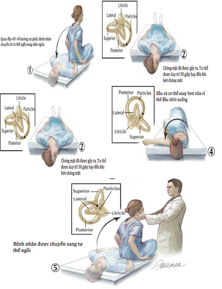 Cách điều trị chứng chóng mặt kịch phát tư thế lành tính