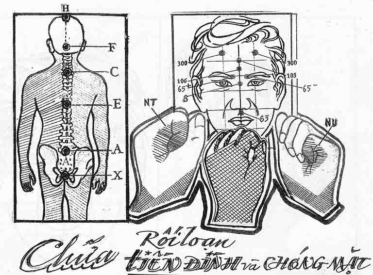 Chữa rối loạn tiền đình bằng phương pháp diện chẩn