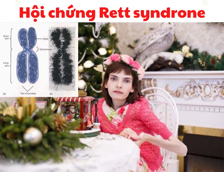 Hội chứng Rett