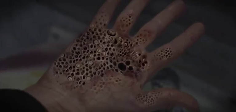 trypophobia là gì