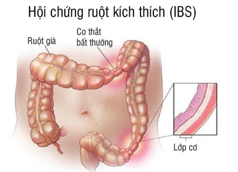 căng thẳng gây ảnh hưởng dạ dày